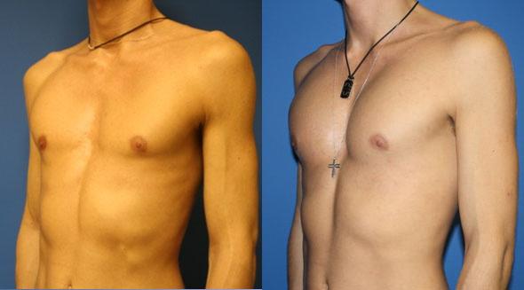 Know the procedure of male breast reduction